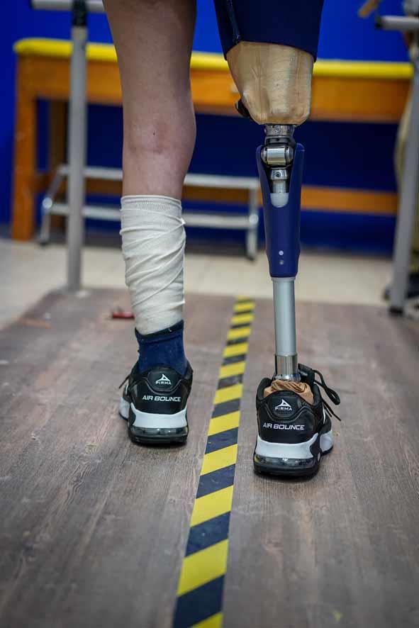 Laboratorio de Órtesis y Prótesis del DIFH transforma la vida de hidalguenses que viven con discapacidad